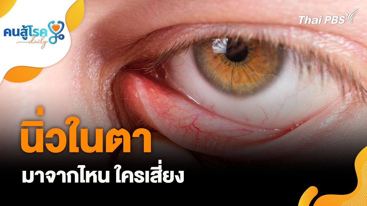 นิ่วในตา มาจากไหน ใครเสี่ยง