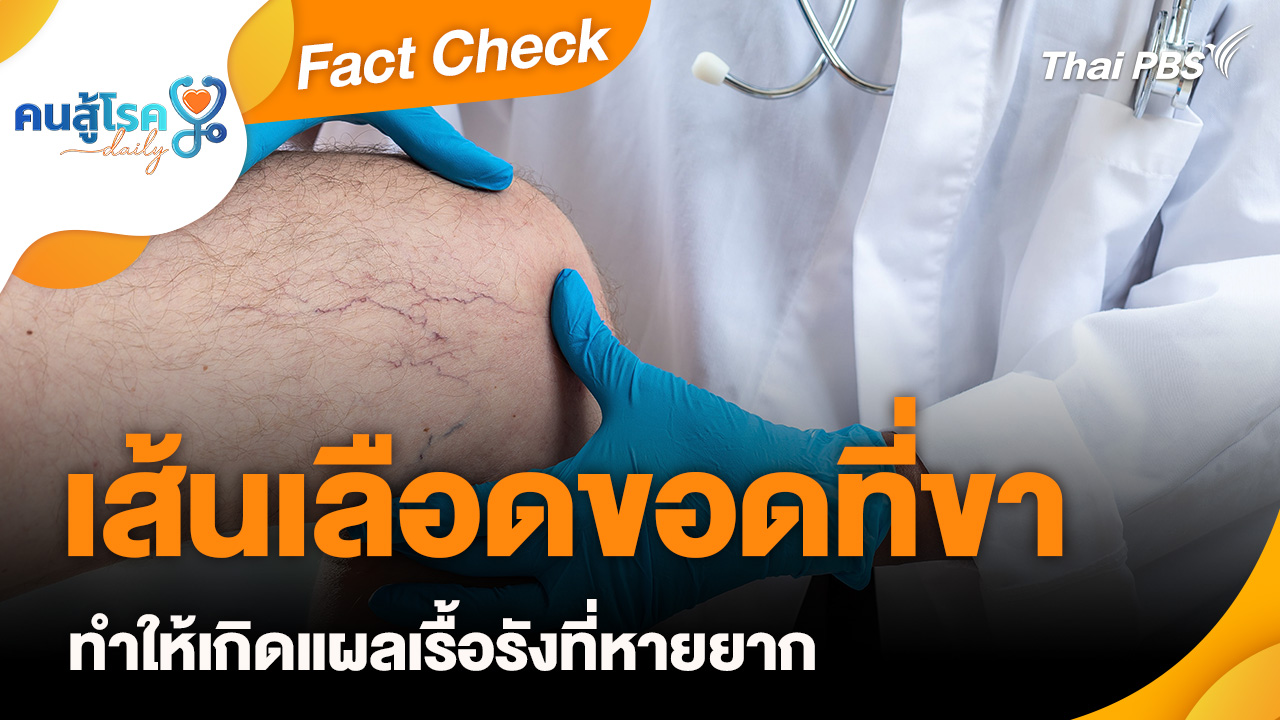 Fact Check : เส้นเลือดขอดที่ขา ทำให้เกิดแผลเรื้อรังที่หายยาก